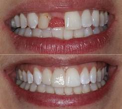 Dental Bridge Dubai